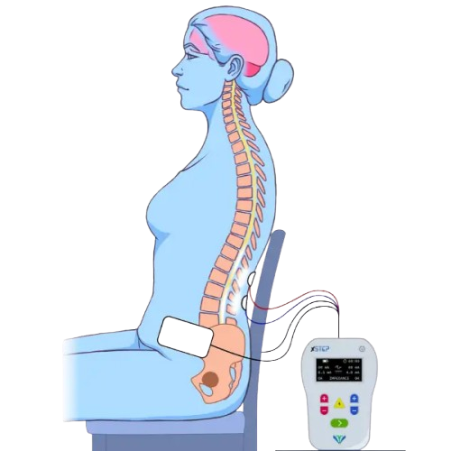 xStep neuromodulation system illustrating spinal stimulation for gait rehabilitation